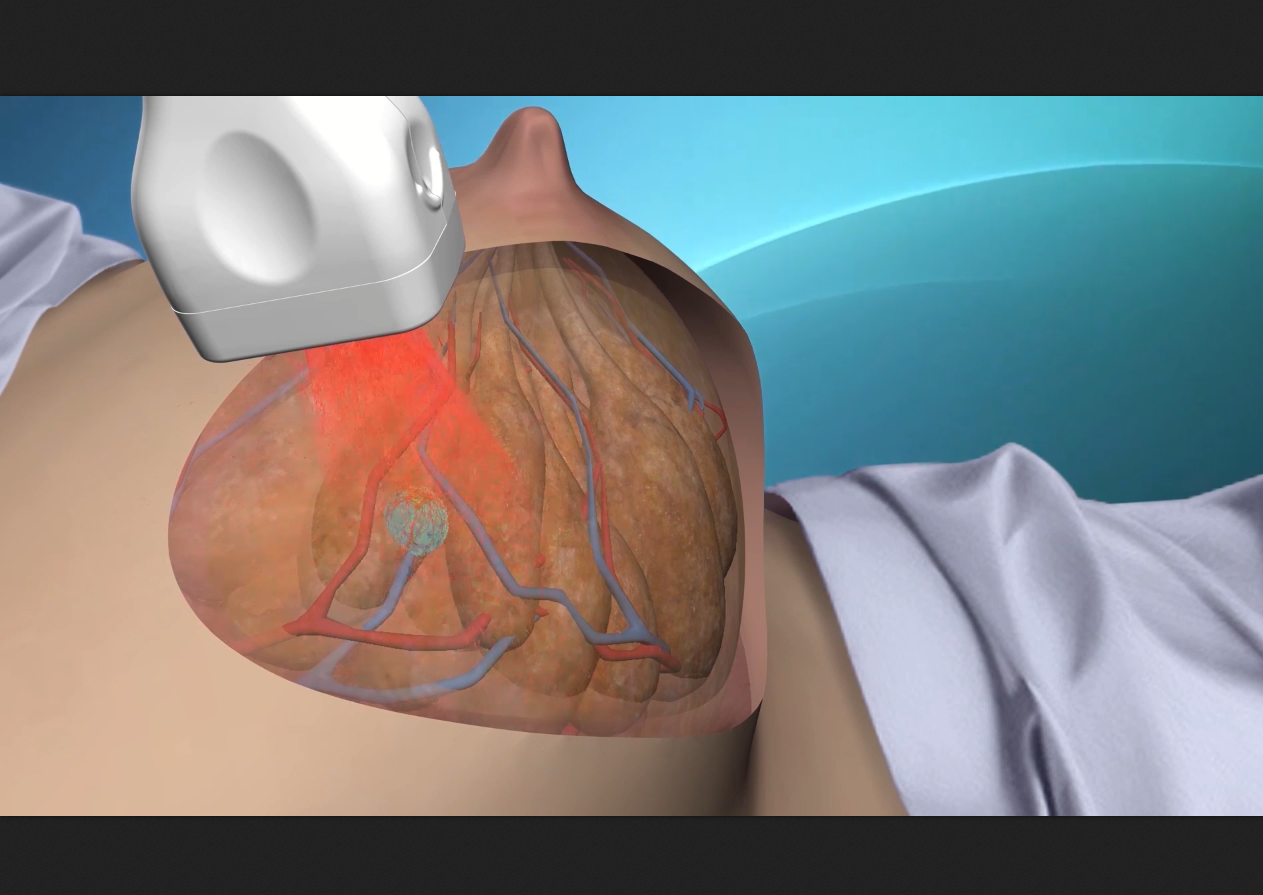 Seno Medical: Imagio™ 3D Medical Device Video